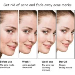 Aichun Beauty Anti-Acne Whitening Serum with Aloe Vera 30ml - Image 4