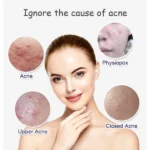 Aichun Beauty Anti-Acne Whitening Serum with Aloe Vera 30ml - Image 6